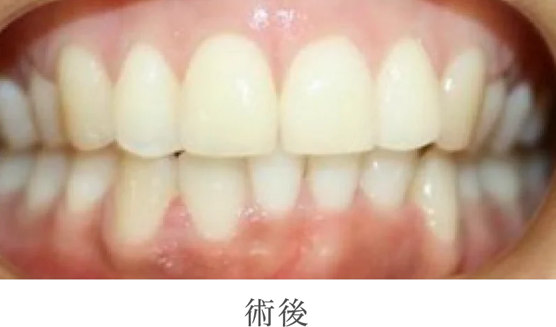 術後