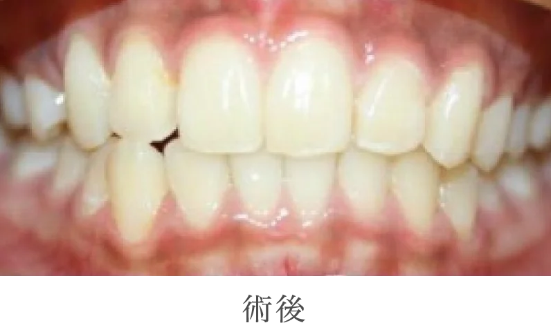 術後